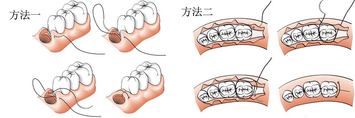 牙周治疗手术缝合线缝合方法示意图.jpg